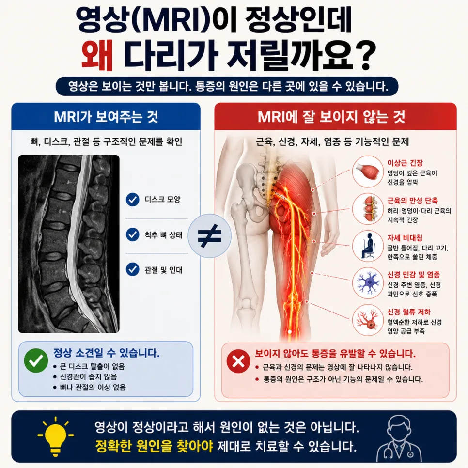 척추·근육·신경 세 층으로 보는 좌골신경통