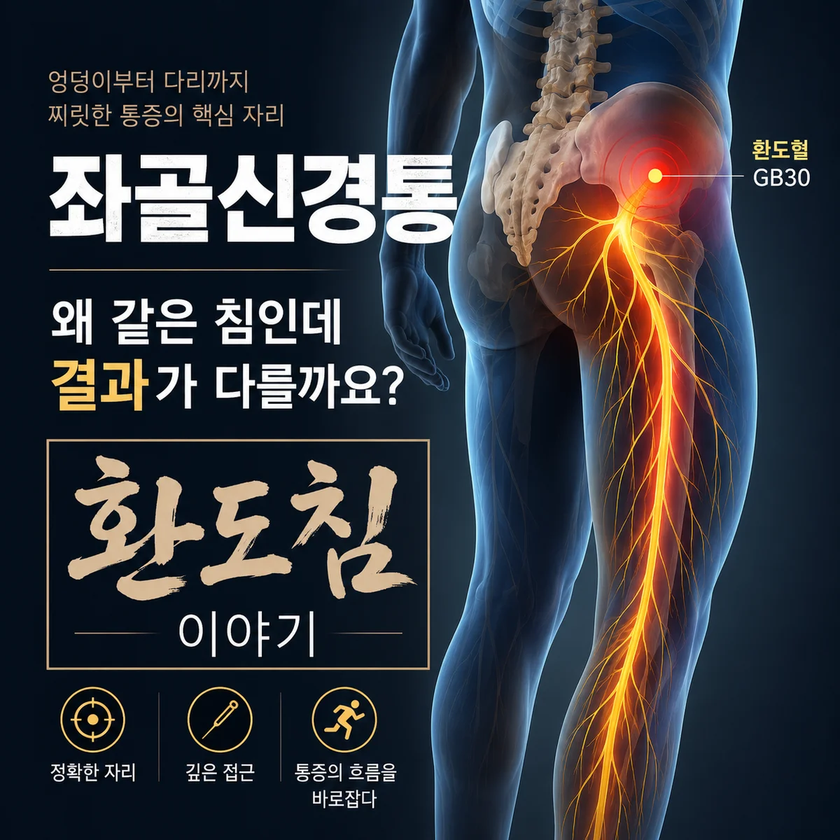 환도혈·환도침 — 분당 미금역 올봄한의원