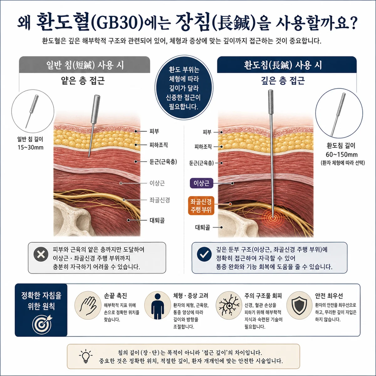 진료실에서 자주 보는 환도침 시술의 흐름