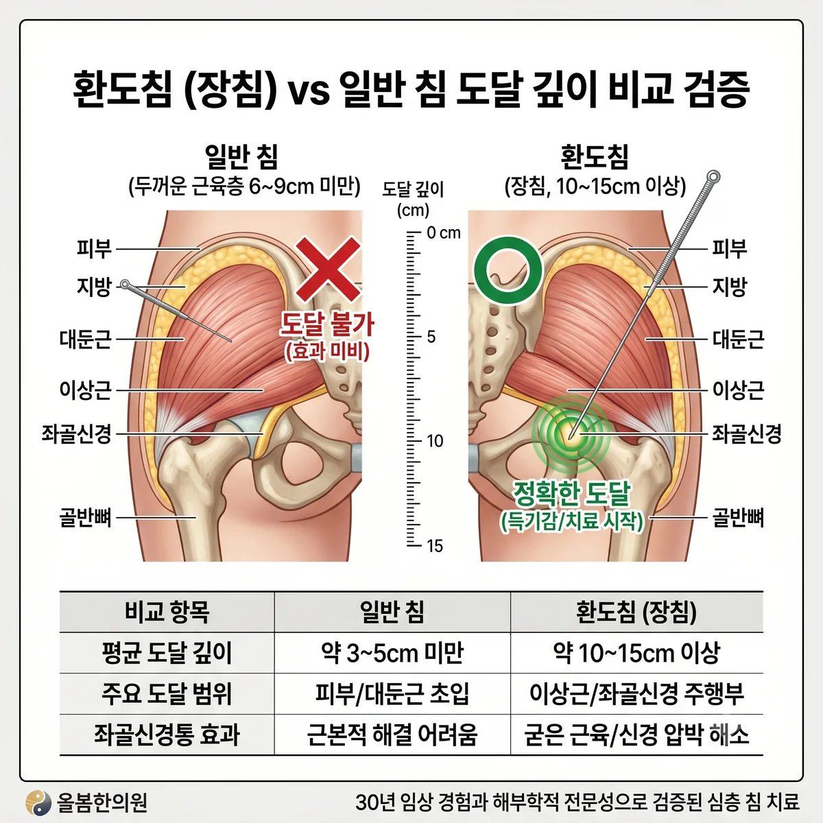 환도혈·환도침 — 올봄한의원